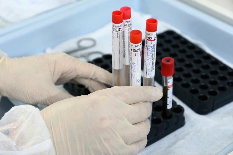 В ОРЛО зафиксировали 23 новых случая COVID-19, 5 летальных